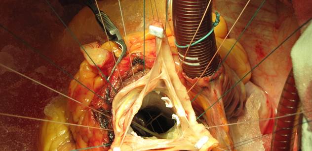 Aneurysma aorty