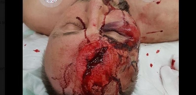 Drastické FOTO z Německa: Poslance AfD mlátili a kopali do hlavy. Krev a díra v hlavě