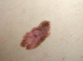 Počet lidí nemocných kožním melanomem stále vzrůstá, potvrzuje zdravotní pojišťovna