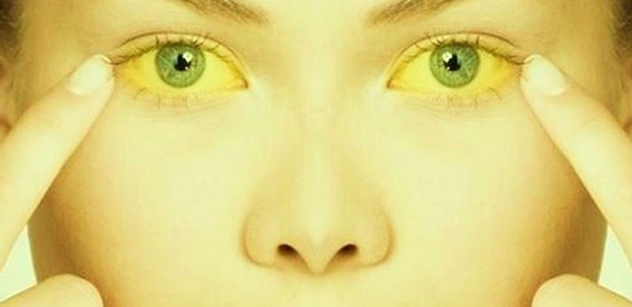 Petr Husa: Žloutnutí očí je jedním z příznaků žloutenky